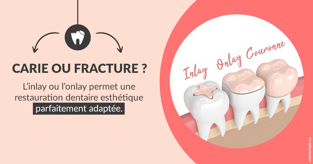 https://dr-nezri-mickael.chirurgiens-dentistes.fr/T2 2023 - Carie ou fracture 2