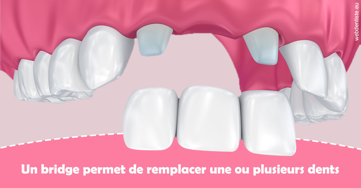 https://dr-nezri-mickael.chirurgiens-dentistes.fr/Bridge remplacer dents 2