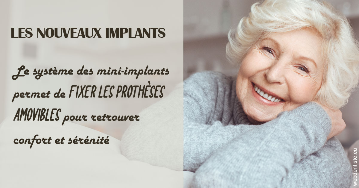 https://dr-nezri-mickael.chirurgiens-dentistes.fr/Les nouveaux implants 1