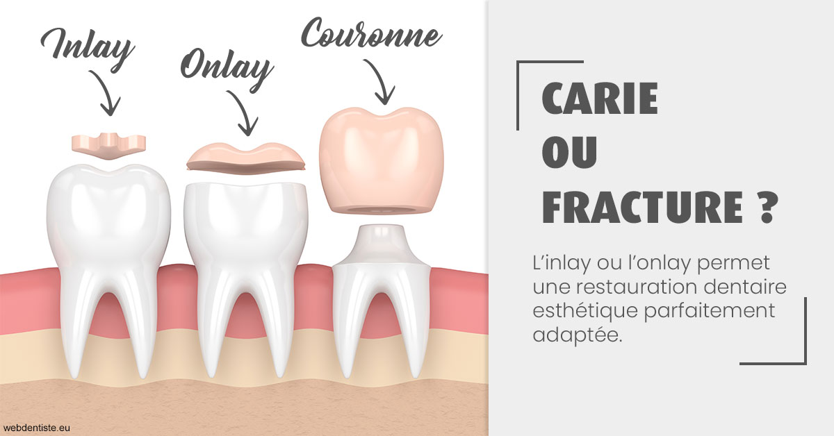 https://dr-nezri-mickael.chirurgiens-dentistes.fr/T2 2023 - Carie ou fracture 1