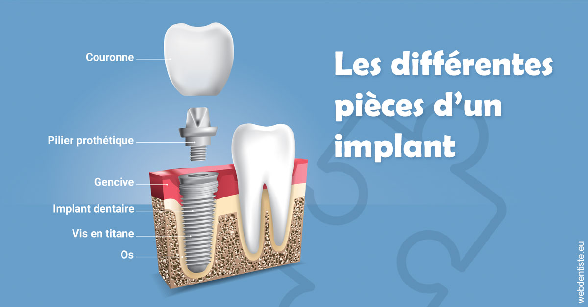 https://dr-nezri-mickael.chirurgiens-dentistes.fr/Les différentes pièces d’un implant 1